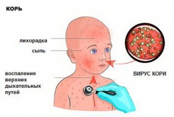 Новости » Общество: В Крыму за три дня выявлено еще 14 новых случаев заболевания корью