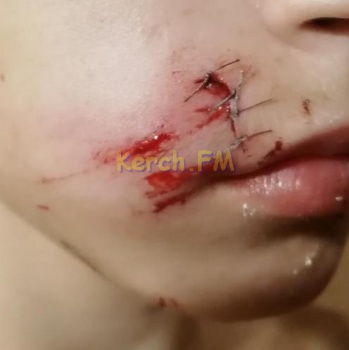 Ребенок  разорвал лицо, когда бежал вдоль бутиков у центрального рынка Керчи